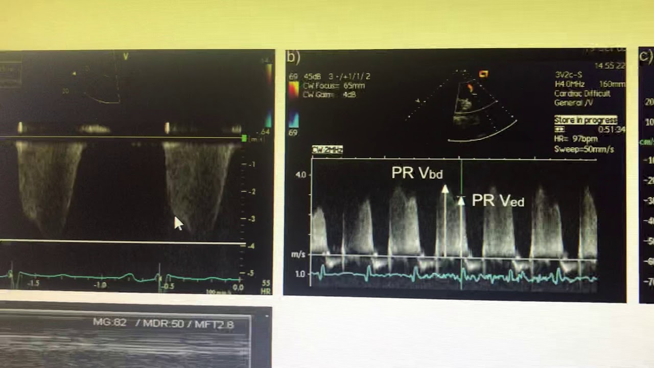 PAEDP and mean PAP by echocardiogram - YouTube