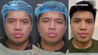 The New Hollywood Spectra  laser for enlarged pores and acne scar treatment