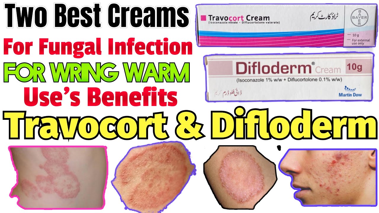 Two Best Cream For Fungal Infection Travocort &Diflodem Uses