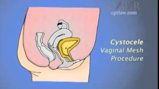 Pelvic Organ Prolapse - Transvaginal Mesh