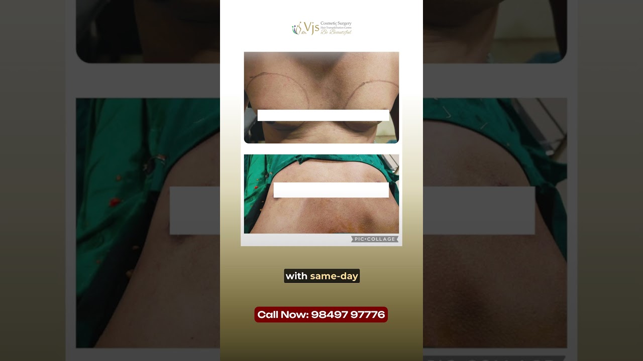 Built Your Body but Still Hide Your Chest? | Gynaecomastia Surgery Vizag | What Helps?