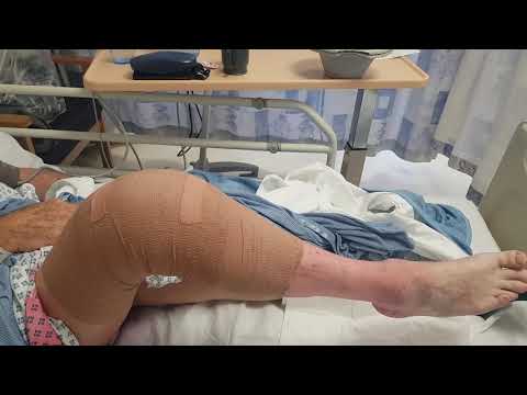 1 hour following total knee replacement. Enhanced recovery