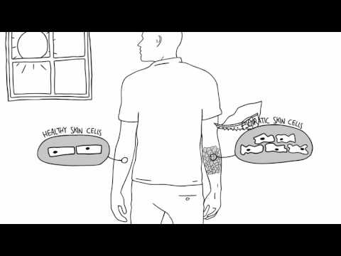 psoriasis treatment neutralizing