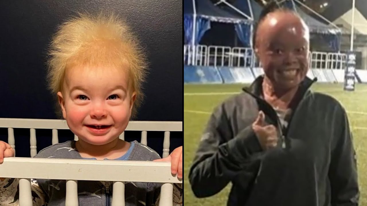 ⁣Uncombable Hair Syndrome and Other Rare Genetic Conditions