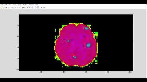 IDENTIFICATION AND DETECTION OF BRAIN TUMOUR SEGMENTATION USING FUZZY AND NEURAL NETWORK