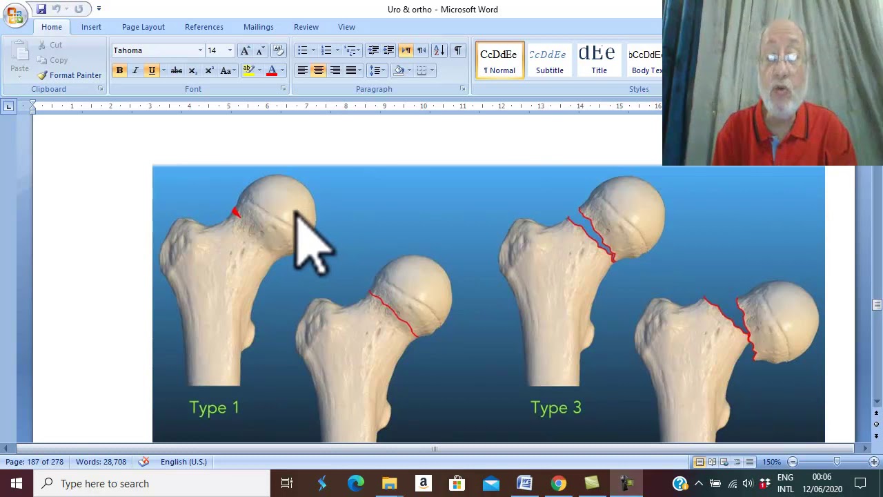 Orthopedic in Arabic 33 ( Intracapsular femoral neck fracture  , part 1), by Dr.Wahdan