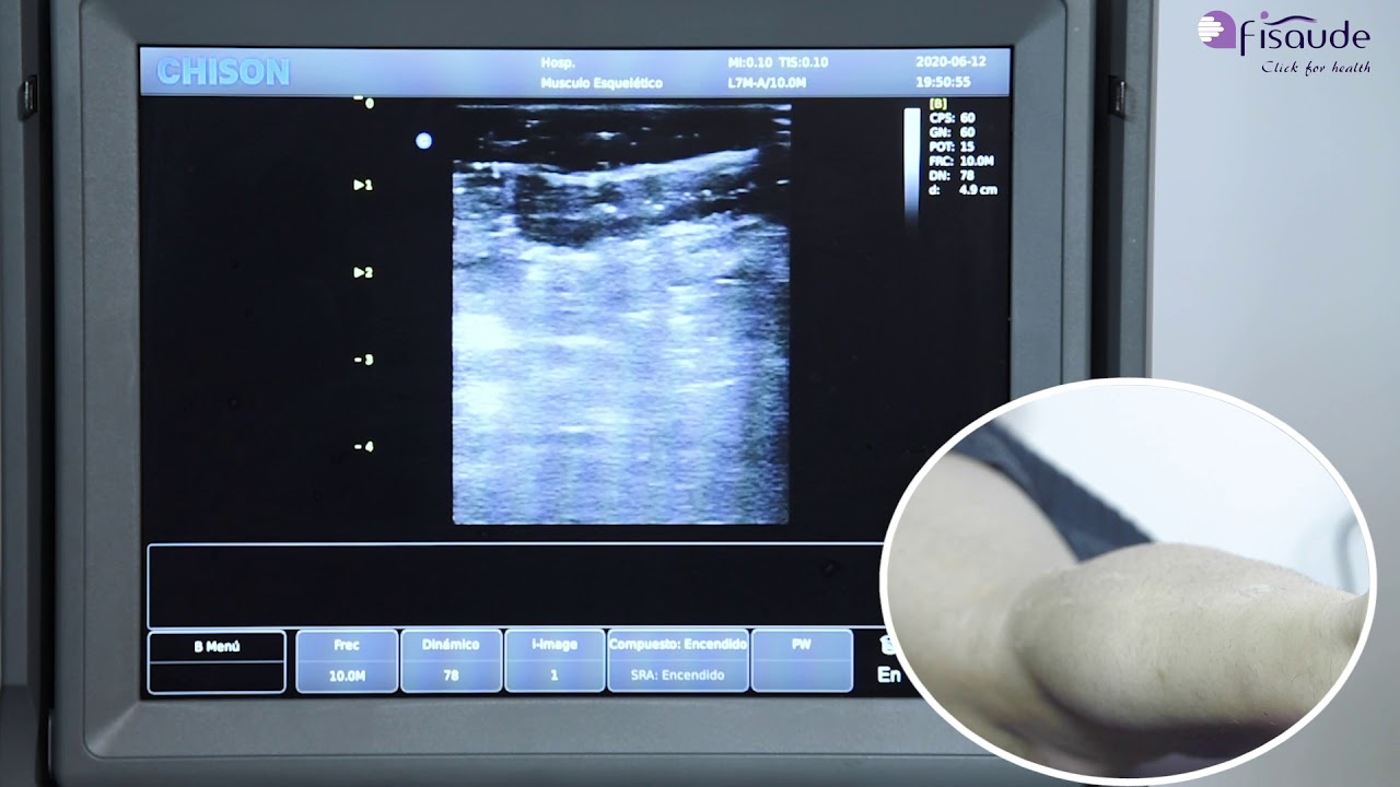 Ecografía del gemelo y de la fascia plantar con el ecógrafo Chison Eco 2