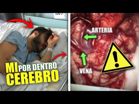 Así Quedó Mi Cerebro Por Dentro Después de La Operación... *IMÁGENES REALES*