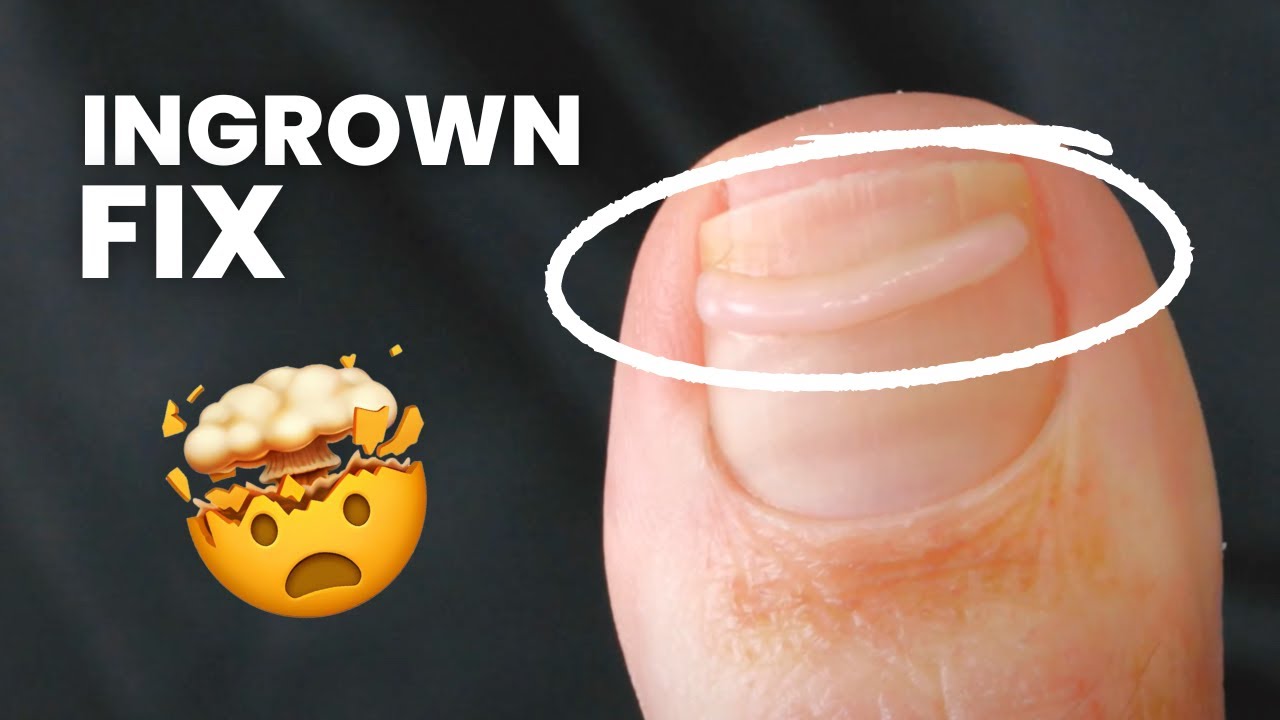 Ingrown Nails in Howell | Howell Ingrown Nails | Ingrown Nails 07731