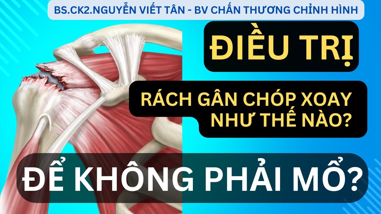 ĐIỀU TRỊ RÁCH GÂN CHÓP XOAY NHƯ THẾ NÀO ĐỂ KHÔNG PHẢI MỔ? - Khớp Việt ...