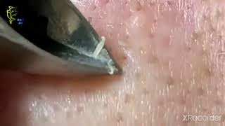 Rahatlatıcı Sivilce Ve Siyah Nokta Sıkma Videoları تهدئة البثور والرؤوس السوداء الفيديو.