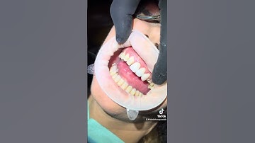 Transform your smile with our top-quality veneers! ✨