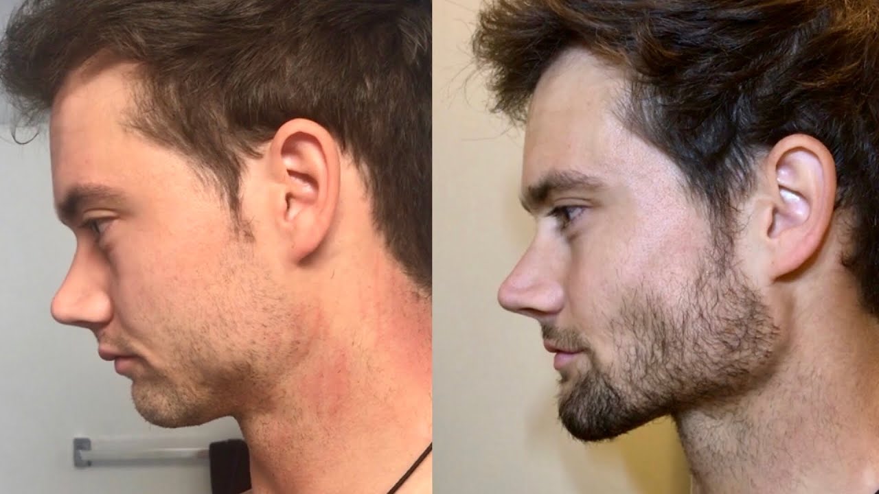 30 Day Face Transformation Mewing Fasting Connor Murphy Youtube