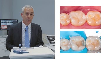 DENTSPLY - Direct Restorations έΑΥ The Class II Solution