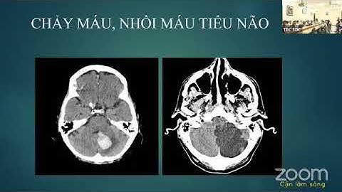 CHÓNG MẶT VÀ RỐI LOẠN TIỀN ĐÌNH | TS. BS. TRỊNH TIẾN LỰC