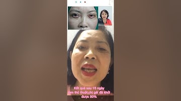 Sau 15 ngày khắc phục lại mí mắt dưới bị lật ngửa đã ổn định/Thành Công Tiểu Phẫu.
