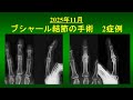 手指ブシャール結節の手術2症例　（2025年11月施行）屈筋腱切除・人工関節