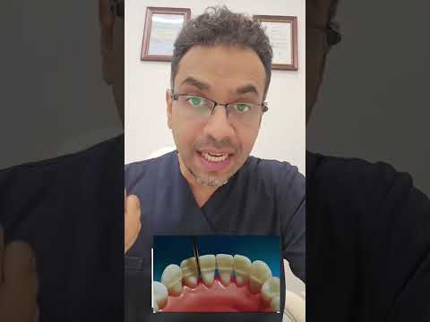 اعراض و علاج حركة الأسنان