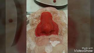 Silicone Nose Prosthesis By Dr Hiren Babariya-Prosthetist And Orthotist-Gold Medalist