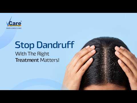 Dandruff Explained | Types of Dandruff & Advanced Treatment at VCare