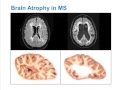 Pathogenesis of Neurological Disability in Multiple Sclerosis