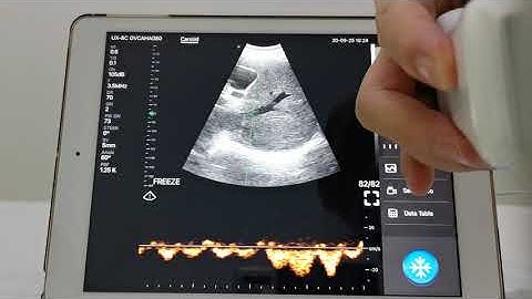 Highest Cost-effective wireless handheld ultrasound scanner-D2CL