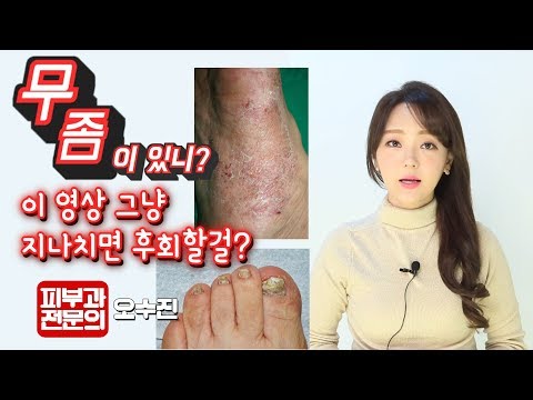 (*<strong>Eng</strong>) 무좀에 대한 모든 것 ! Athlete&amp;#39;s foot can be all <strong>over</strong> the body! 피부과전문의 (dermatologist) 오수진
