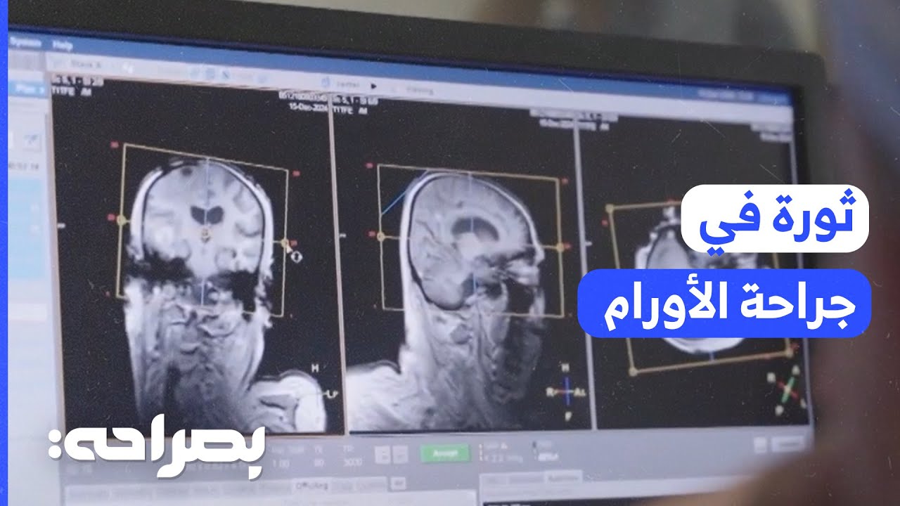 مركز الحسين يجري أول عملية لورم دماغي بتقنية متطورة - بصراحة
