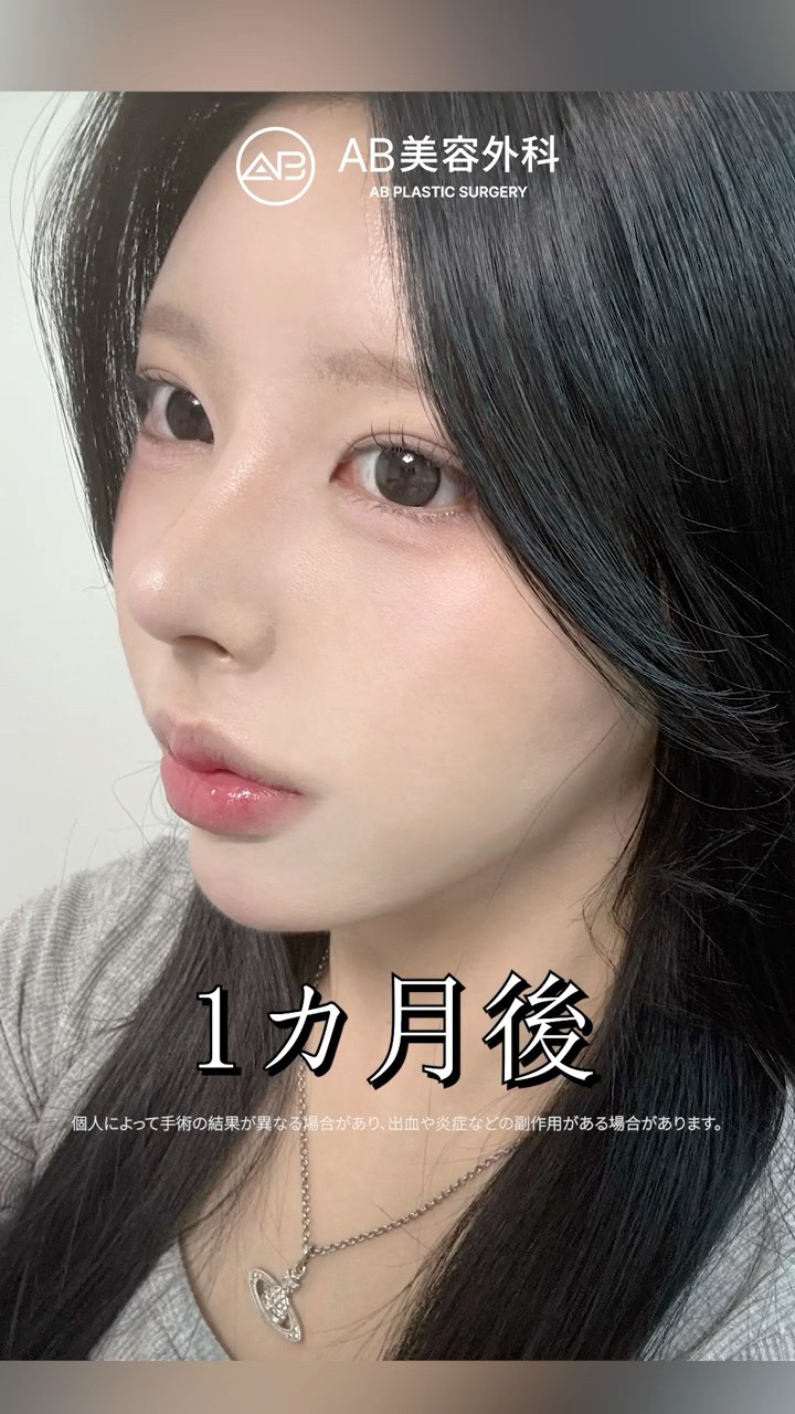 鼻整形で自信がついた彼女🤍 #Shorts