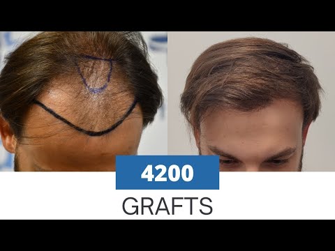 12 Monate nach meiner Haartransplantation | Elithair