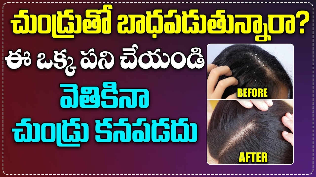 చుండ్రు పోవడానికి సులువైన మార్గం..? | How to Remove Dandruff in One Day |  Tips For Hair in Telugu - YouTube