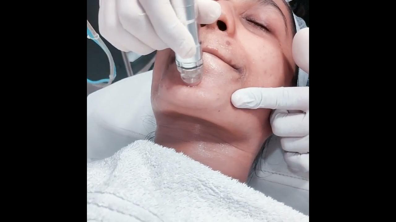 what is hydrafacial? Acne skin hydrafacial hydrafacial for skin