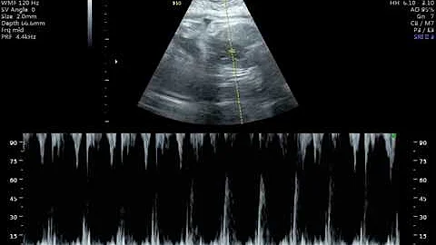 Qual é a ultrassom que faz com 32 semanas?