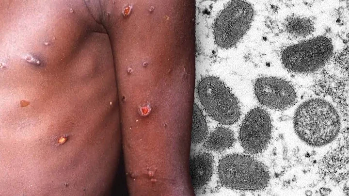 Rare Monkeypox Virus Found in Several Countries - DayDayNews