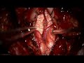 Microsurgical Resection of an Inferior Medullary Cavernous Malformation