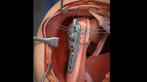 Proximal Humerus Fracture. (ORIF-Through the Deltopectoral Approach)