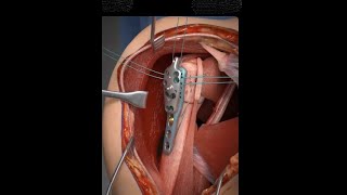Proximal Humerus Fracture. (ORIF-Through the Deltopectoral Approach)