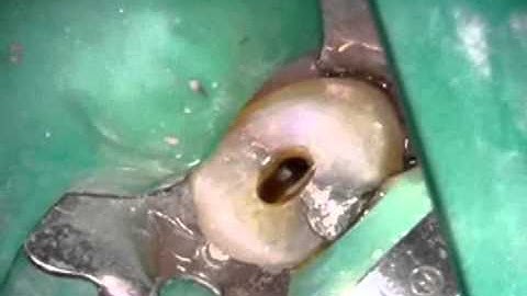 Endodontics Torabinejad 14-2C Maxillary Premolars