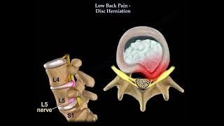 Lumbar Disc Herniation Causes, Symptoms and Treatment