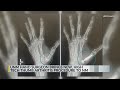 UNM hand surgeon offering new way to help those suffering from thumb arthritis