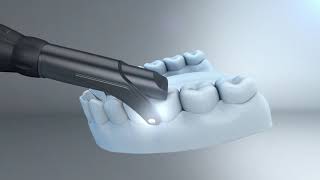 Welcome to DEXIS CariVu™, transillumination caries detection device