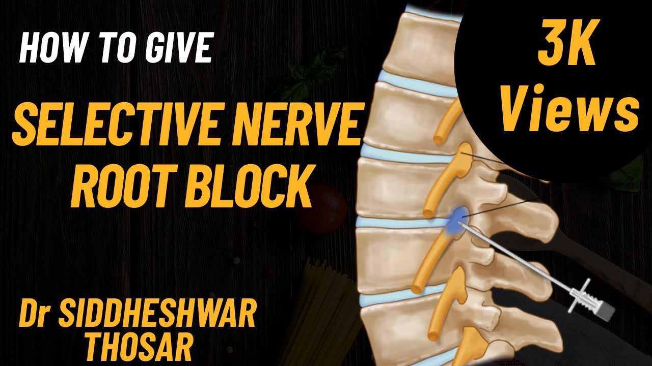 Selective Nerve Block Injection In detail technique of giving selective nerve root block ...
