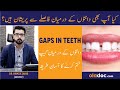 Gaps In Teeth Causes Treatment - Danto Ke Gap Ko Kaise Bharen - How To Close Gap Between Teeth