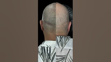 Sẹo, sẹo sau cấy tóc lấy tóc tự thân để lại, đi xăm tóc che sẹo cấy tóc  #xămtóc #xămtócchesẹo