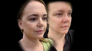 The 5 Layer Neck Lift - A Patient's Journey