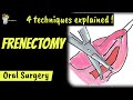 FRENECTOMY SURGICAL TECHNIQUES