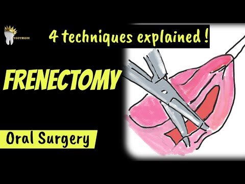 4 Techniques of FRENECTOMY Surgery | Why is frenum removed?