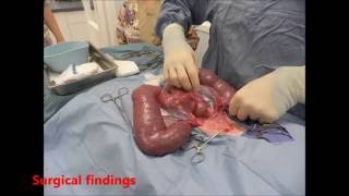 Hydrometrocolpos, Debbi