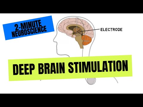 2-Minute Neuroscience: Deep Brain Stimulation