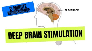 2-Minute Neuroscience: Deep Brain Stimulation